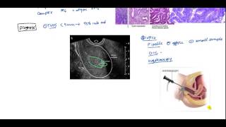 Endometrial Cancer and Hyperplasia for USMLE [upl. by Cyrie]