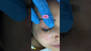 Eye Brow perfect shape with Electrolysis permanent Hair Removal [upl. by Aydne]