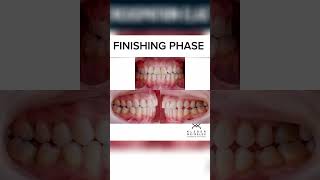 FINISHING PHASE  ORTHODONTIC TIPS Shorts [upl. by Laddy]