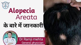 What is Alopecia Areata Patchy Hair Loss Alopecia Areata Treatment in Hindi Dr Ramji mehta [upl. by Ayifas619]