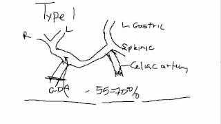 Whipple Procedure Hepatic Arterial Anatomy [upl. by Shanan401]