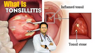 Tonsillitis  Causes Signs Treatment Symptoms In Hindi [upl. by Bortman]