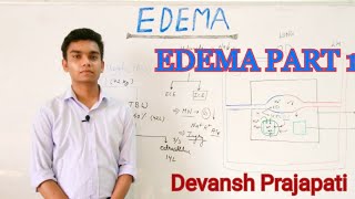 EDEMA PART 1 Pathophysiology intracellular edema [upl. by Atinar]