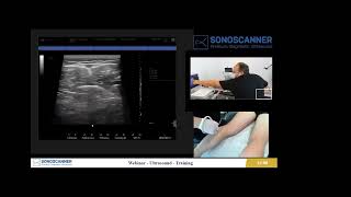 Vidéo diagnostic  Recherche de phlébite à léchographie [upl. by Tnattirb]