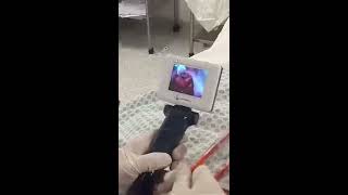 Anesthesia Intubation in Brazil Difficult Airway Intubation BESDATA Video Laryngoscope [upl. by Bracci]