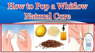 How to Pop a Whitlow Natural Cure [upl. by Zohara]