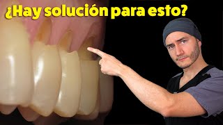 Desgastes en el cuello de los dientes  Causa y Solución  Abfracción Dental [upl. by Adyela]