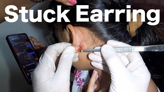 Earring Stuck Inside Her Earlobe for Months  How Its Removed [upl. by Athena539]