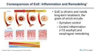 The Latest on New Options for Eosinophilic Esophagitis Considering Targeted Biologic Therapy [upl. by Mathian]