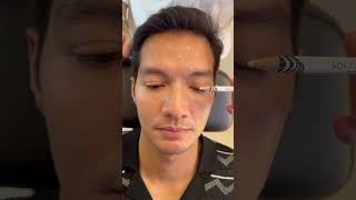 Botox for Men Brotox botox botoxinjections botoxfillers [upl. by Mauralia]