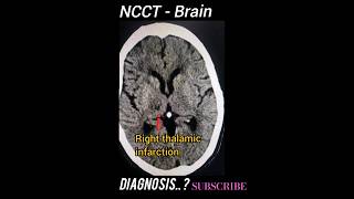 Thalamic Stroke  NCCT Brain  Diagnosis  Practical case [upl. by Hoseia]