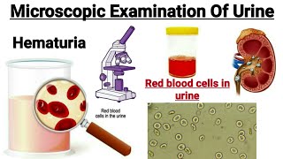 Microscopic examination of urine  Causes of Red blood cells in urine  Hematuria in hindi [upl. by Inavoj]