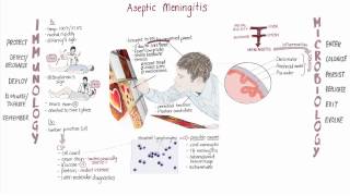 Enterovirus Meningitis Springboard [upl. by Nnylekoorb]