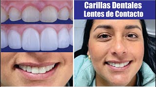 CARILLAS DENTALES sin DESGASTAR el DIENTE 🦷 Carillas tipo LENTES DE CONTACTO 👄 Dr SANTIAGO BURGA 3D [upl. by Fredrika]