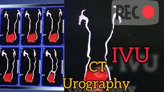 CT UROGRAPHYct urographyIVUSOMATOMgo [upl. by Betthezul]