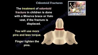 Odontoid Fractures  Everything You Need To Know  Dr Nabil Ebraheim [upl. by Jany]