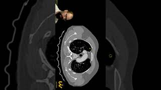 Identificando tromboembolismo pulmonar TEP na angiotomografia de tórax  protocolo TEP short [upl. by Evelina]