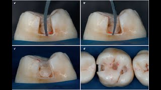 Class II Amalgam Preparation [upl. by Almeta148]