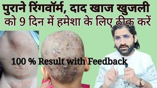 Rigworm Daad khaj ke liye naya herbal treatment fungal new home treatment 100 Result [upl. by Imis]