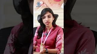 മുഖക്കുരു ചികിൽസിക്കേണ്ട ആവശ്യം ഉണ്ടോ  Acne treatment malayalam [upl. by Michey]