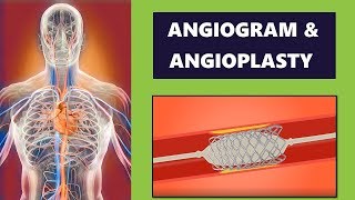 Angiogram and Coronary Angioplasty Procedure Cardiology [upl. by Anny456]