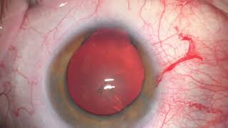 Cataract surgery and congenital iris coloboma repair  Singlepass fourthrow pupilloplasty [upl. by Gannon756]