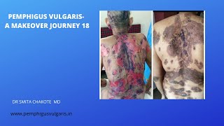 PEMPHIGUS VULGARIS A MAKEOVER JOURNEY 18 [upl. by Ania]