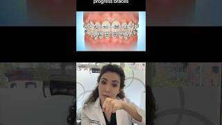 How Can Orthodontic Elastics Help With Your Braces [upl. by Ola]