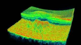 Topcon 3D OCT  Soft Drusen [upl. by Clintock562]