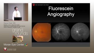 Overview White Dot Syndrome  Birdshot Retinochoroidopathy [upl. by Buatti]