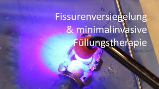 Fissurenversiegelung und minimalinvasive Füllungstherapie [upl. by Rozella370]