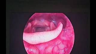 laryngeal papilloma papillomavirus hoarseness cough entsurgeon drbaisalisarkar kolkata [upl. by Nonohcle]