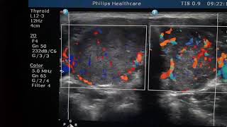 Thyrotoxicosis Sonography [upl. by Anoik853]