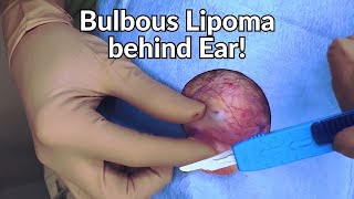 what the sigma dermatologist rizzles lipoma from behind the ear [upl. by Cryan]