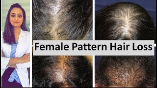 Hair loss in women  Female Pattern Hair Loss  causes amp treatment  Dermatologist [upl. by Sanchez895]