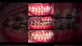 ارتودنسی با کشیدن دندان به کمک مینی اسکرو Orthodontics by extracting teeth with mini screws [upl. by Anastassia665]