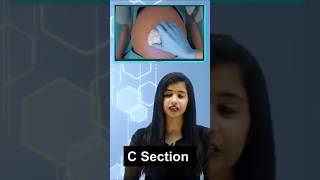 Normal Delivery VS C  Section Delivery  Pooja Mam class10preparation shorts class12 [upl. by Mattheus]