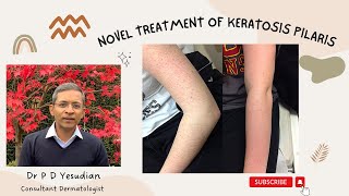 A novel treatment for Keratosis pilaris [upl. by Gnaw515]