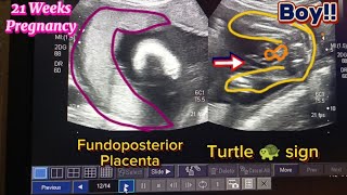 baby boy with fundoposterior placenta on ultrasound [upl. by Ferrick]