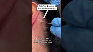 Skin Tag Removal With Radiofrequency  Quick amp Safe Treatment DRMEDISPA [upl. by Merissa]