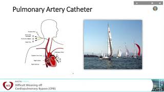 Haemodynamic and other Monitoring during weaning off CPB  Eric Benedet Lineburger Brasil [upl. by Dovev]