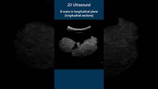 2D Ultrasound Bscans  Example 1 [upl. by Camroc]