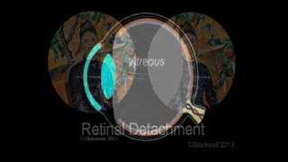 Retinal Detachment [upl. by Nanice]