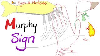 Murphy Sign for Cholecystitis  Signs in Medicine Series [upl. by Aremaj509]