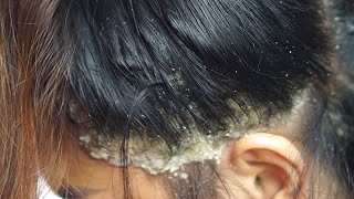 Dandruff scratching removal on head using black combing98 [upl. by Murtagh]