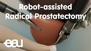 Robotassisted Radical Prostatectomy RARP [upl. by Gittel328]