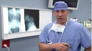 Candidates for Spinal Fusion Surgery [upl. by Orji761]