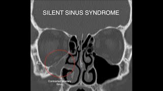 Silent Sinus Syndrome [upl. by Bresee]