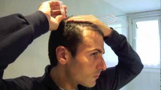 Tratamiento laser capilar domiciliario  Hair loss laser treatment home use [upl. by Adikam90]