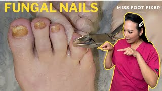 Complete Fungal Nail Treatment A StepByStep Guide  Miss Foot Fixer [upl. by Justen951]